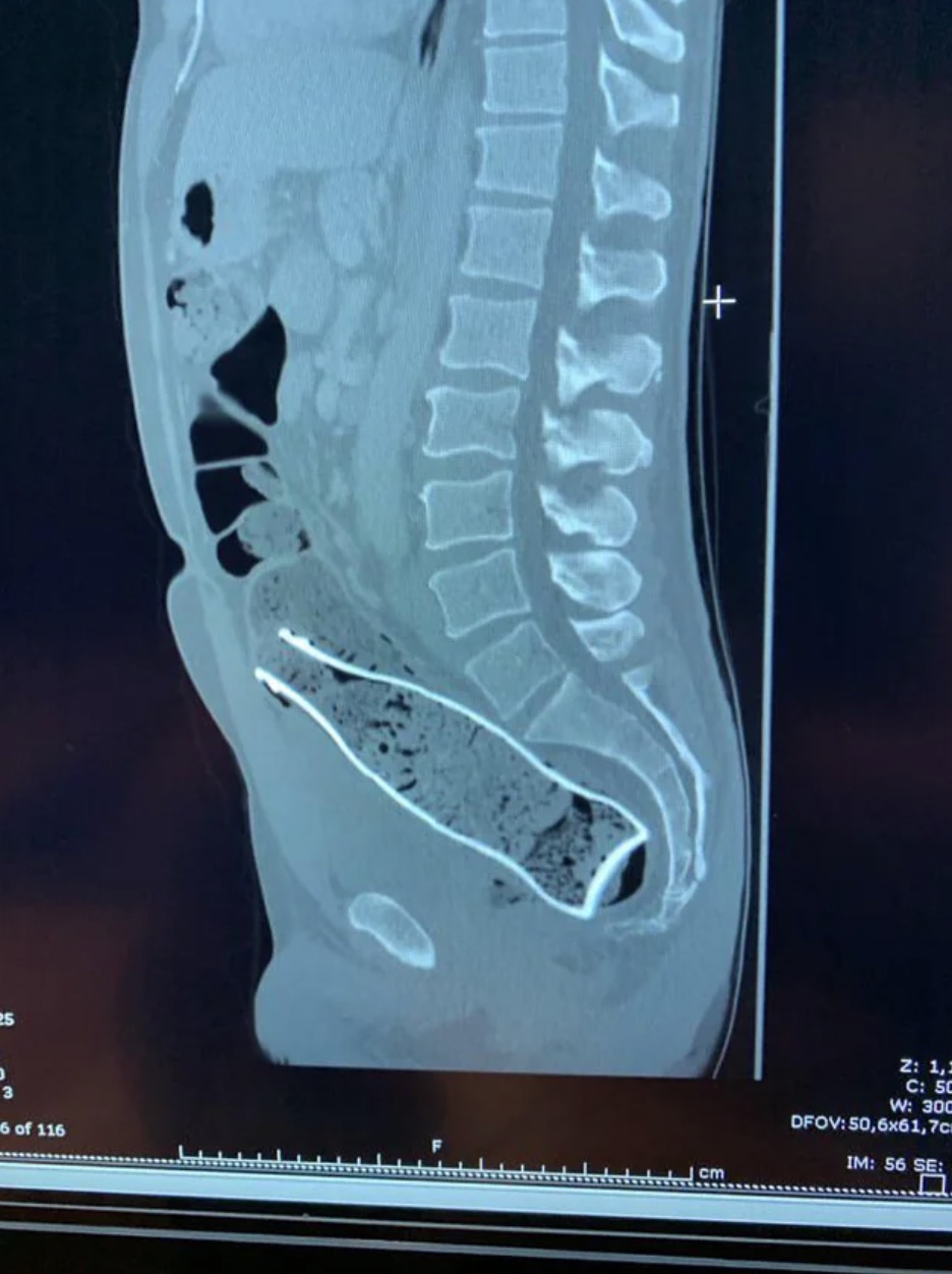 computed tomography - 3 25 6 of 116 F cm Z 1,1 C 50 W 300 Dfov 50,6x61,7c Im 56 Se